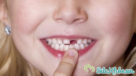 Nếu răng sữa bị gãy thân - chân răng hoặc gãy chân răng thì nên nhổ bỏ.