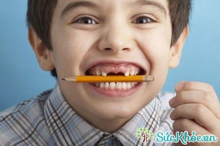 Chấn thương răng trẻ em thường gặp ở các bé trai nhiều hơn bé gái