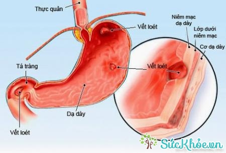 Biểu hiện của viêm hang vị dạ dày điển hình cho các bệnh liên quan đến dạ dày