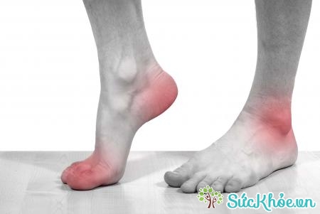 Viêm khớp là nguyên nhân gây đau chân vào mùa đông