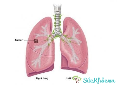 Bệnh bụi phổi amiăng là tình trạng xơ phổi