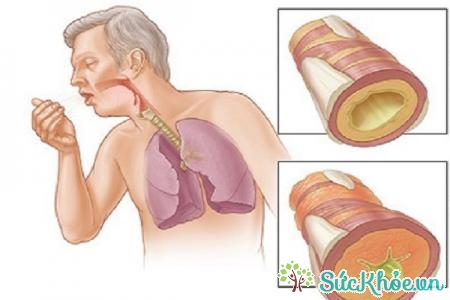 Ung thư phổi xảy ra khi các tế bào phổi tang trưởng nhanh bất thường