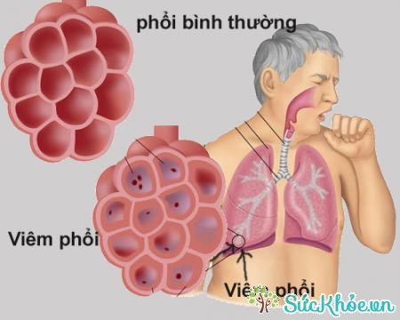 Người già mắc viêm phổi phế cầu có biểu hiện lú lẫn
