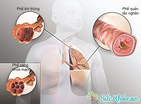 Bệnh bụi phổi bông là hình thức của bệnh hen suyễn