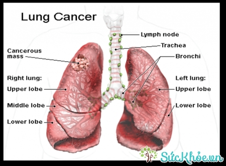 Bạn nên ngừng hút thuốc khi được chẩn đoán là mắc ung thư phổi