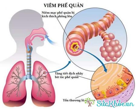 Viêm phổi phế cầu do một loại vi khuẩn gây ra