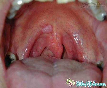 Ung thư vòm họng giai đoạn đầu rất khó phát hiện