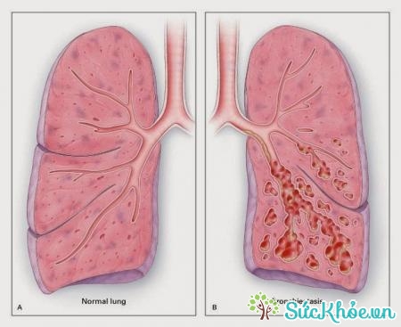 Hít phải di vật là nguyên nhân chính gây áp xe phổi
