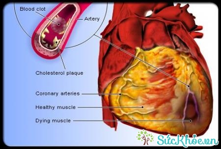 LDL cholesterol do một số bệnh như suy giáp gây ra