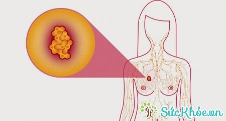 Nguyên nhân gây bệnh ung thư vú là gì?