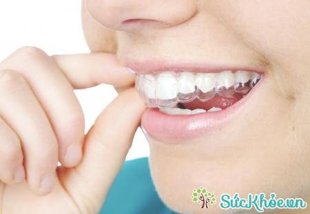 Phát hiện răng khấp khểnh giúp rút ngắn thời gian điều trị