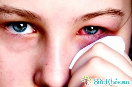 Cách chữa đau mắt đỏ bằng bài thuốc dân gian