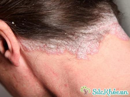 Bệnh vảy nến da đầu ảnh hưởng đến toàn bộ da đầu, có thể lan ra trán