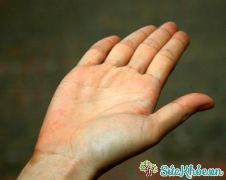 Vết chai thường xuất hiện trên tay hoặc bàn chân