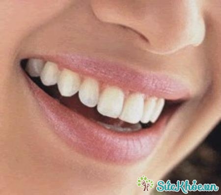 Áp xe răng là tình trạng nhiễm trùng do sâu răng gây ra