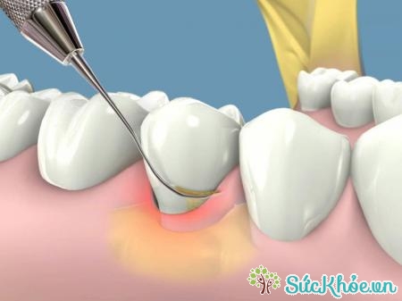 Viêm nướu răng khiến nướu sưng và dễ chảy máu
