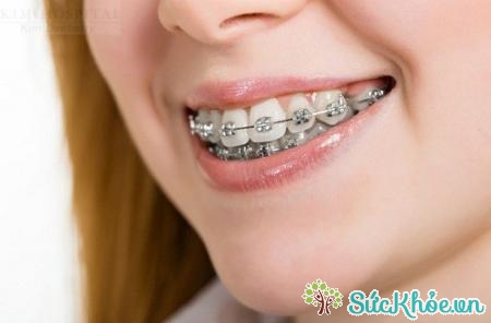 Niềng răng chỉnh nha là giải pháp để chữa sai lệch khớp cắn
