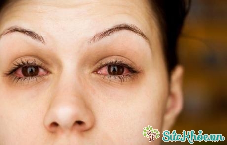 Bệnh khô mắt là một trong những bệnh liên quan đến nước mắt