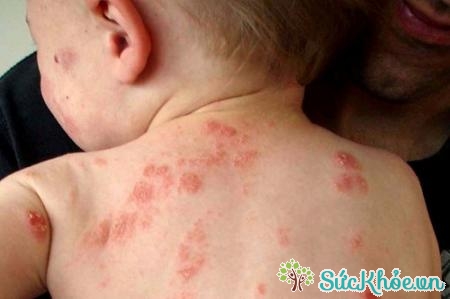Trẻ bị viêm da cơ địa hoặc chàm thường có biểu hiện đỏ ngứa