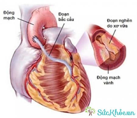 U nhầy nhĩ trái hay còn gọi là u nhầy nhĩ