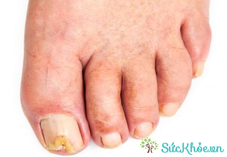 Nấm da bàn chân là bệnh phổ biến