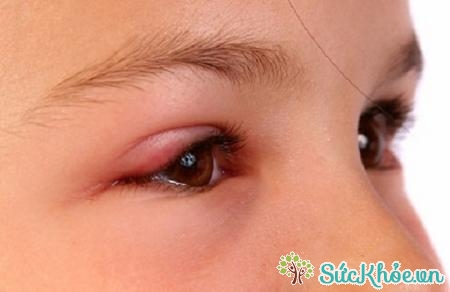 Phù mi mắt là một tác dụng phụ khi dùng thuốc