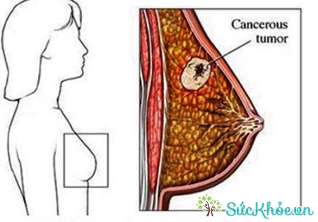 Trong số ít trường hợp, nam giới cũng mắc ung thư vú