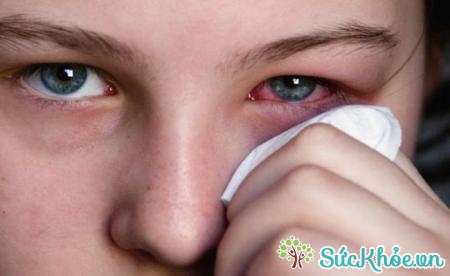 Dị ứng mắt thường xảy ra trên người có cơ địa dị ứng kèm theo các loại bệnh dị ứng khác của cơ thể