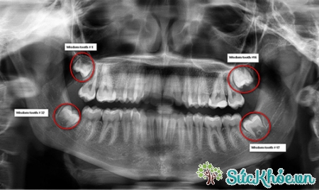 Khi bệnh nhân có biến chứng do răng khôn hàm dưới mọc lệch làm sưng đau góc hàm thì phải điều trị kháng sinh