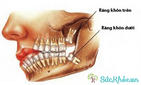 Răng khôn mọc kẹt có thể gây viêm nhiễm do thức ăn bị dắt không làm sạch được hoặc do sang chấn vào lợi
