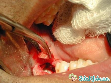 Quá trình mọc lên không hoàn chỉnh của răng khôn là nguyên nhân để hình thành nên những khối u xương hàm
