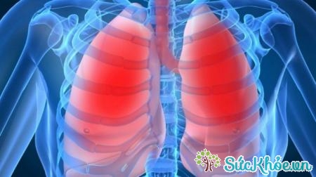 Tràn dịch màng phổi là biến chứng của bệnh sốt xuất huyết