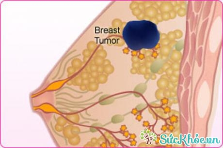 Hình ảnh khối u trong bệnh ung thư vú