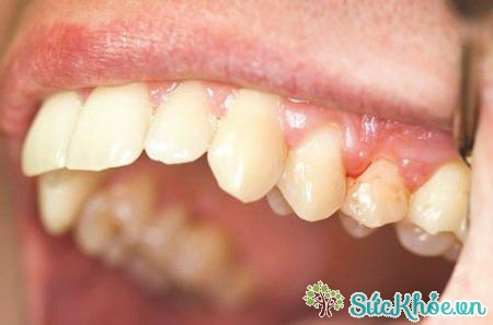 Nguyên nhân gây viêm lợi sau khi bọc răng sứ