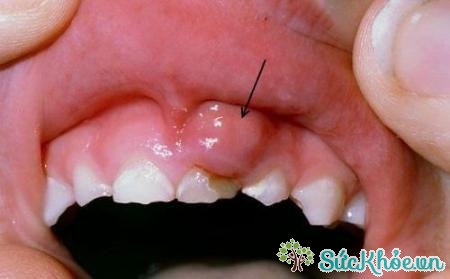 Những ảnh hưởng sau khi bọc răng sứ