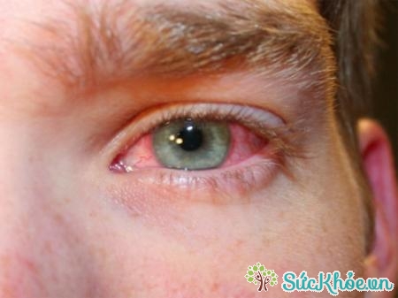 Sung huyết mắt là một phản ứng phụ khi dùng thuốc