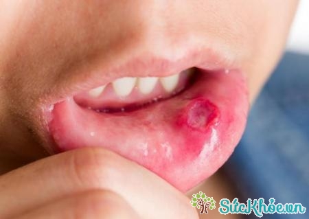 Viêm miệng là tình trạng viêm ở khoang miệng