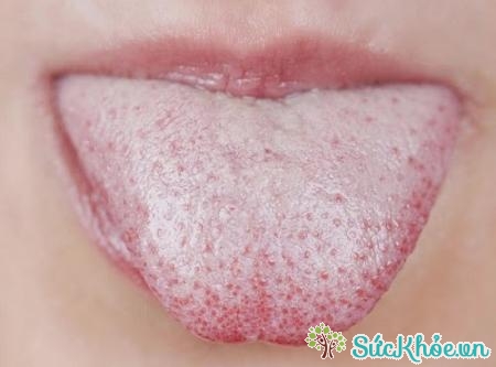Phản ứng phụ có thể xảy ra là nhiễm nấm Candida miệng