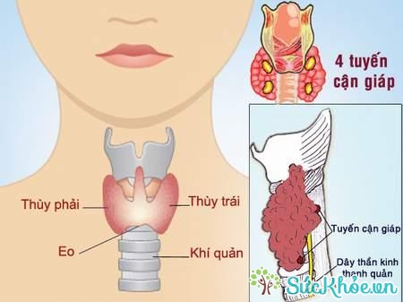 Suy tuyến cận giáp là tình trạng tuyến cận giáp tiết quá ít hormone PTH