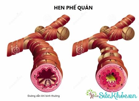 Smart-Air là thuốc dự phòng và điều trị bệnh hen phế quản mãn tính