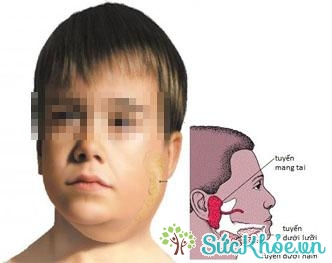 Dấu hiệu nhận biết bệnh quai bị: sưng cứng dưới tai và vùng dưới hàm