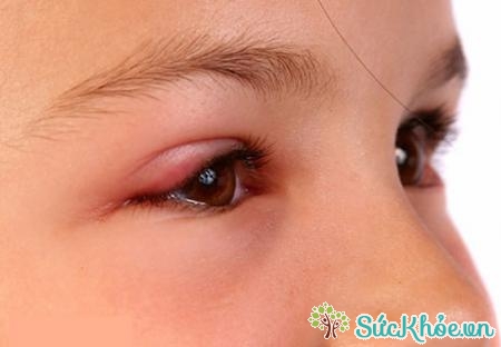 Mắt thường bị đỏ và nhạy cảm với ánh sáng