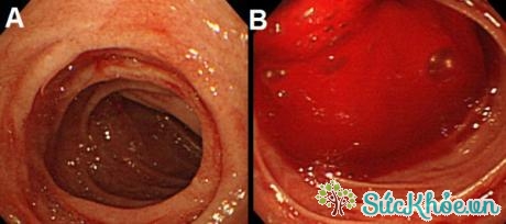 A) Hình ảnh nội soi dạ dày bình thường. B) Hình ảnh nội soi xuất huyết dạ dày