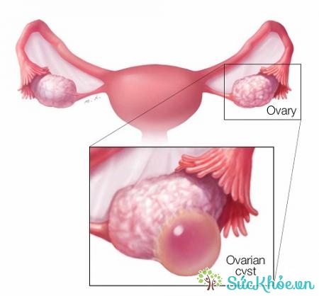 U nang nước buồng trứng là dạng u nang buồng trứng