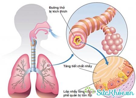 Viêm phế quản mãn tính là một thể của bệnh phổi tắc nghẽn mãn tính