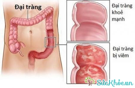 Nguyên nhân gây đại tràng thấp nhiệt là do ăn uống không điều độ, ăn nhiều chất cay nóng