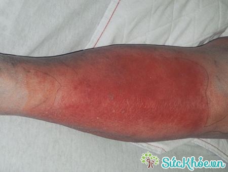 Viêm mô mềm dưới da là bệnh nhiễm trùng phổ biến ở da