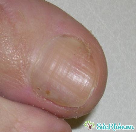 Chín mé là tình trạng bị nhiễm trùng tạo mủ ở các đầu ngón tay
