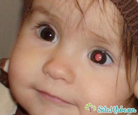 Bệnh nhân thường bị giảm thị lực, mắt đỏ, sưng