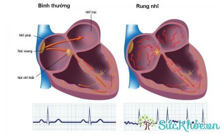 Người mắc hội chứng nút xoang thường gặp nhiều rối loạn nhịp tim